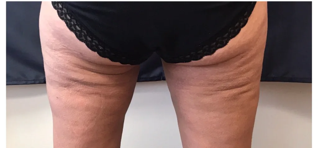 Exilis Ultra, after