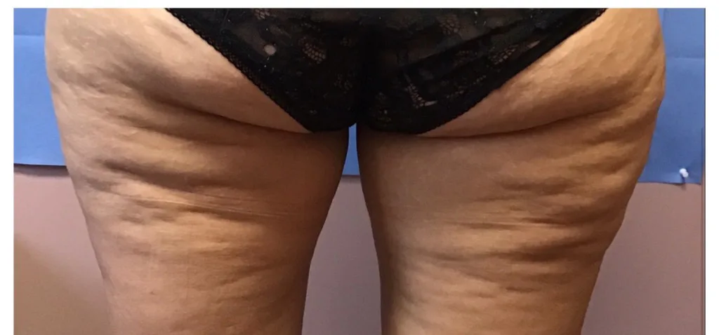 Exilis Ultra, before