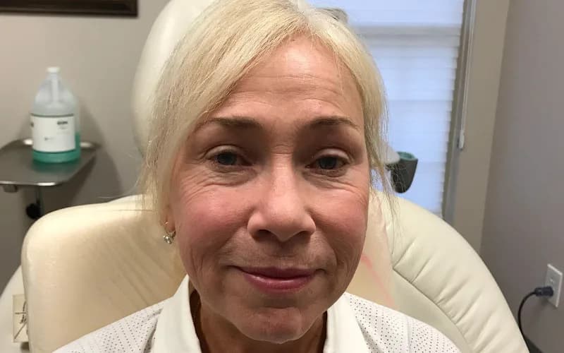 Facial rejuvenation, before