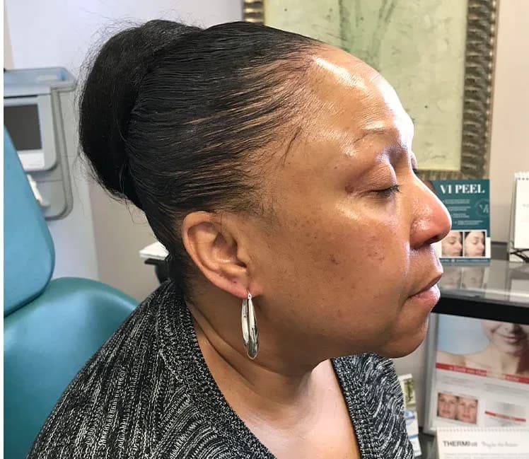 FaceTite, jawline and neck, after