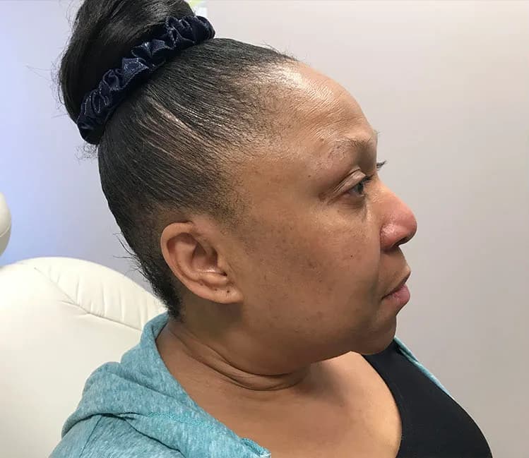 FaceTite, jawline and neck, before