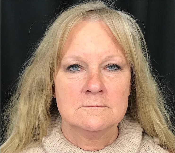 FaceTite, lower face and jawline, after