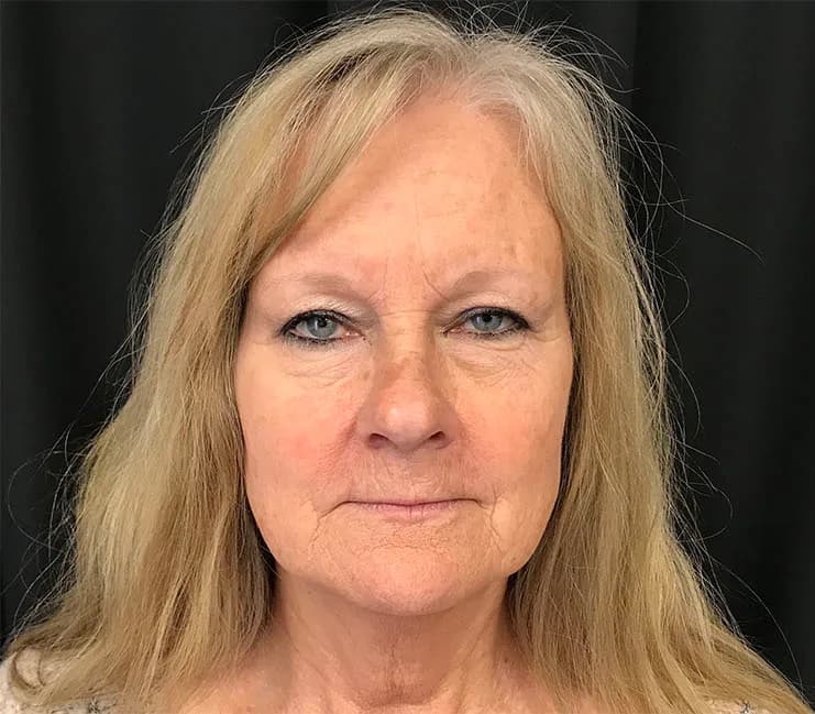 FaceTite, lower face and jawline, before