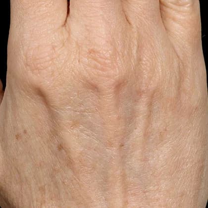Fraxel, age spots on the hands, after