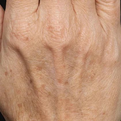 Fraxel, age spots on the hands, before