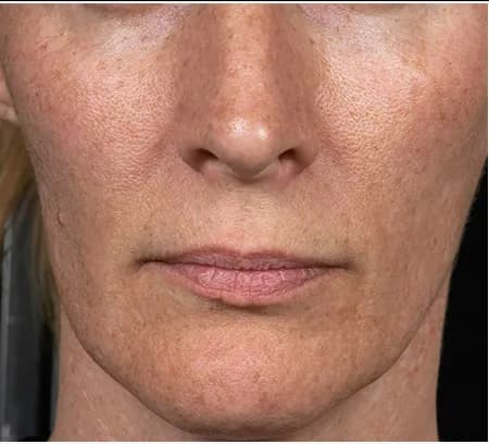 Fraxel for sun damage, front view, after