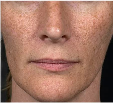 Fraxel for sun damage, front view, before