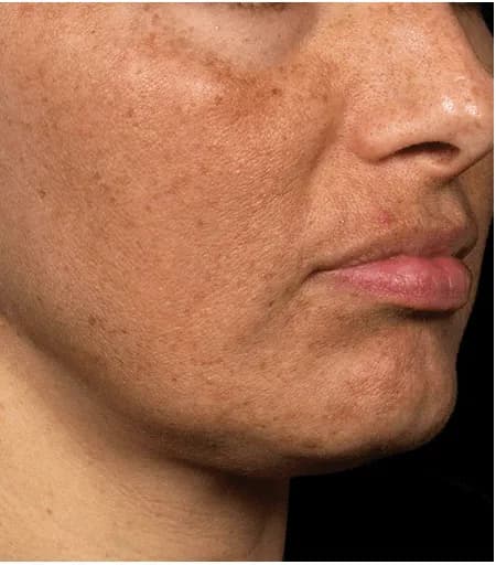 Fraxel for melasma, oblique view, after