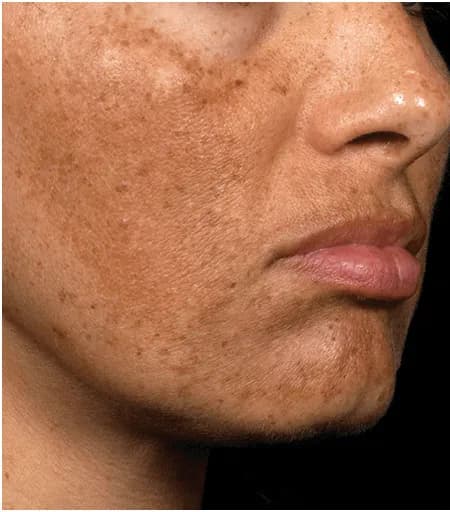 Fraxel for melasma, oblique view, before