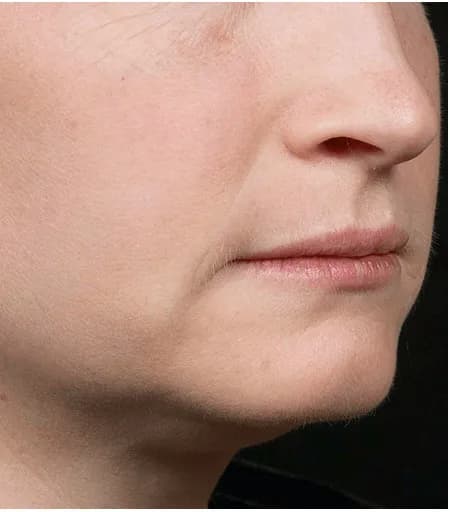 Fraxel, perioral lines and texture, after