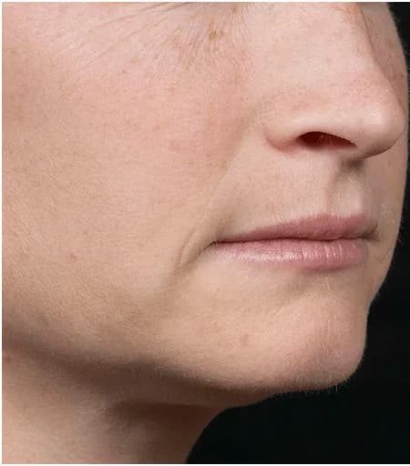 Fraxel, perioral lines and texture, before