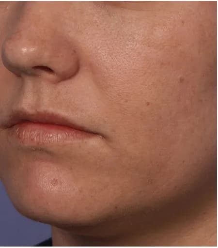 Fraxel for freckling and sun damage, oblique view, after