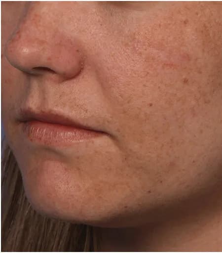 Fraxel for freckling and sun damage, oblique view, before