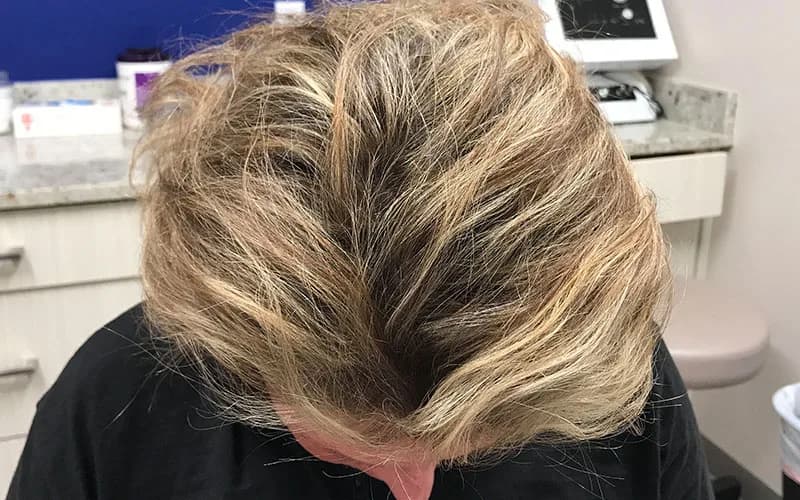 Hair restoration, part line (home page), after