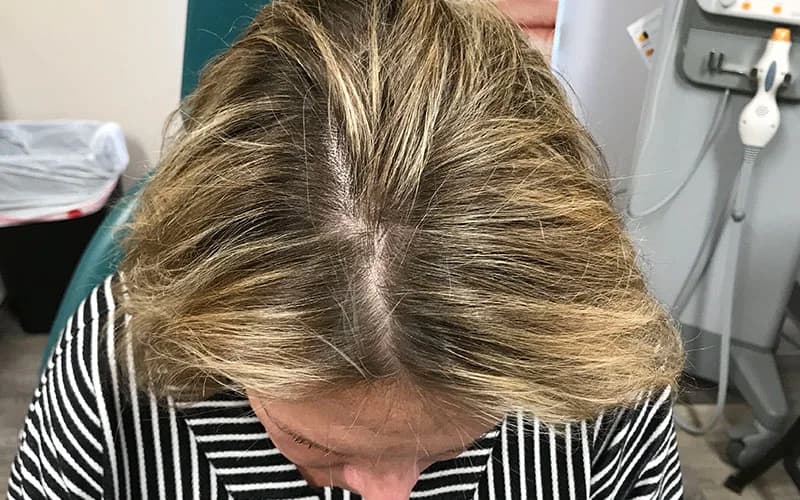 Hair restoration, part line (home page), before