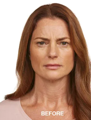 Jeuveau, frown lines, 30 days, before