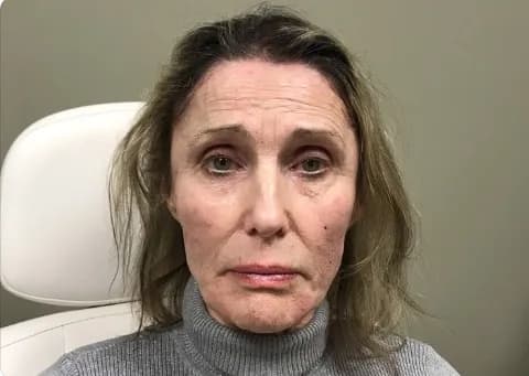 Juvederm facial filler, after