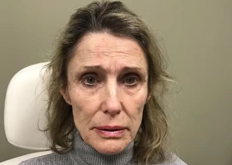 Juvederm facial filler, before