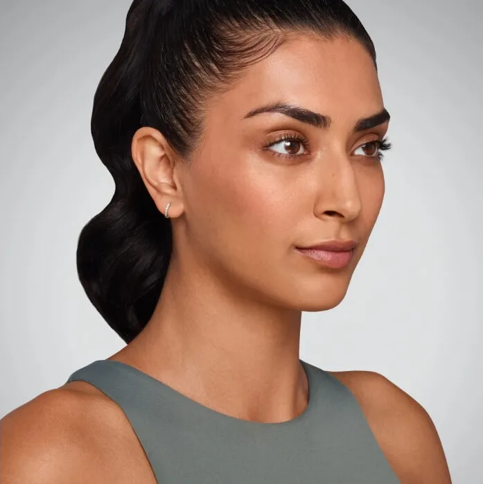 Juvederm results, case one, after
