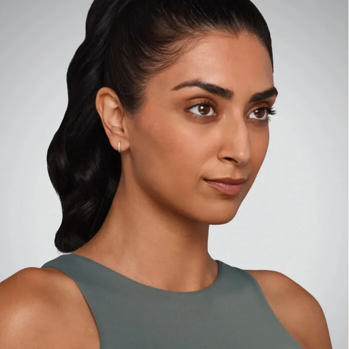 Juvederm results, case one, before