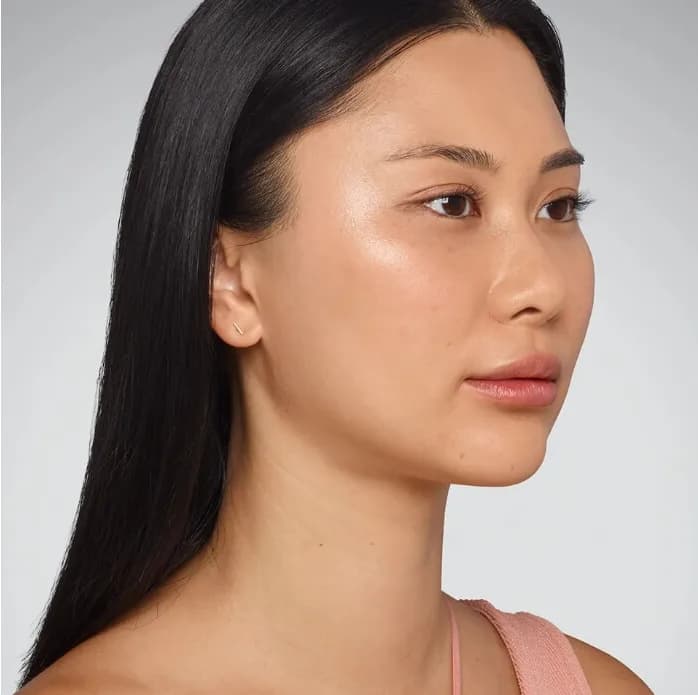 Juvederm, cheeks and lips, after
