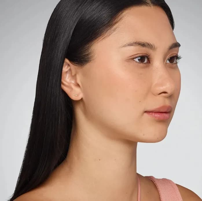 Juvederm, cheeks and lips, before