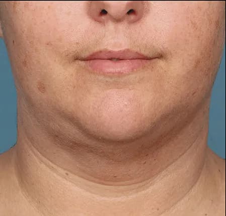 Kybella, front view, after