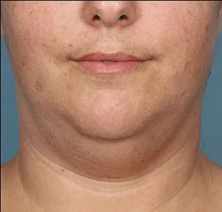 Kybella, front view, before