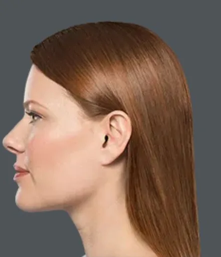 Kybella, after 3 treatments, after
