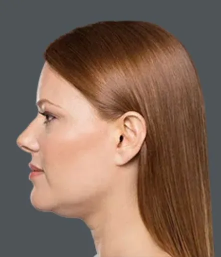 Kybella, after 3 treatments, before