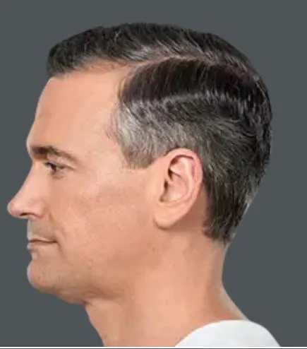 Kybella, after 4 treatments, after