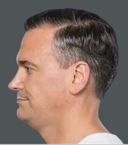 Kybella, after 4 treatments, before