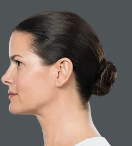 Kybella, after 4 treatments, after