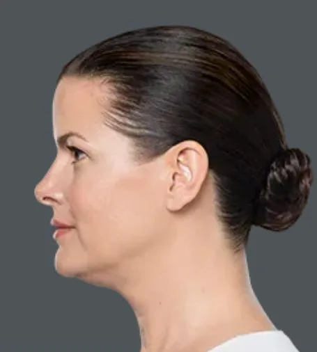 Kybella, after 4 treatments, before