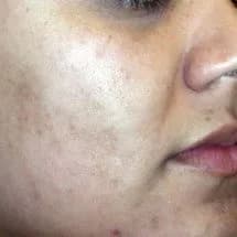 Laser acne treatment, cheek, after