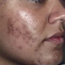 Laser acne treatment, cheek, before