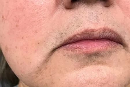 Laser hair removal, chin, after