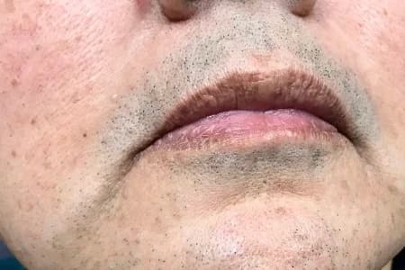 Laser hair removal, chin, before