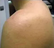 Laser hair removal, shoulder and back, after