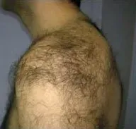 Laser hair removal, shoulder and back, before