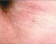 Laser hair removal, bikini line, after