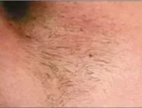 Laser hair removal, bikini line, before