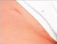 Laser hair removal, underarm, after
