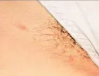 Laser hair removal, underarm, before