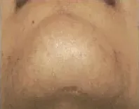 Laser hair removal, chin and jaw, after