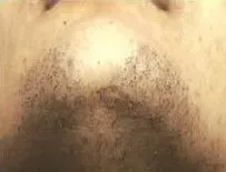 Laser hair removal, chin and jaw, before