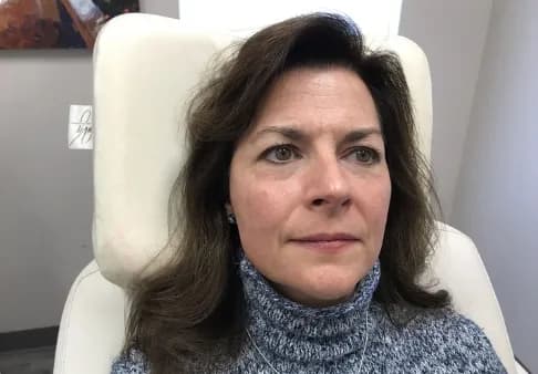 Laser skin resurfacing, full face, front view, after