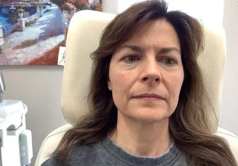 Laser skin resurfacing, full face, front view, before