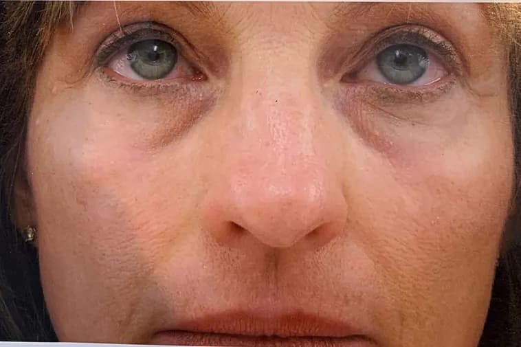 Laser skin resurfacing, mid face, after