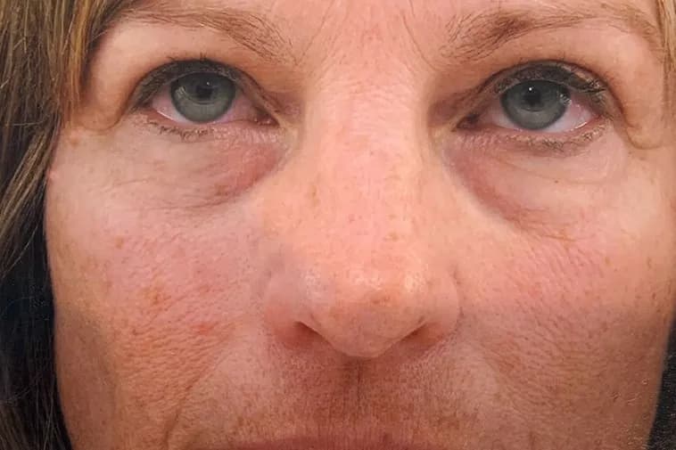 Laser skin resurfacing, mid face, before